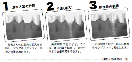 �C���v�����g�̕��@